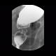 Tumorous stenosis of rectum and sigmoid colon, duplicity, DCBE: RF - Fluoroscopy